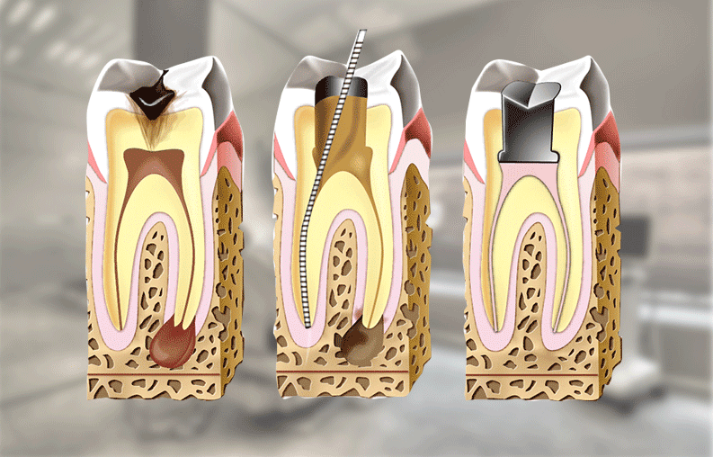 esquema endodoncias