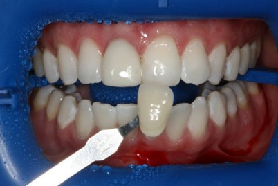 Blanqueamiento Dental Zoom