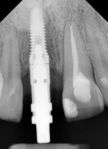 colocacion de implante dental