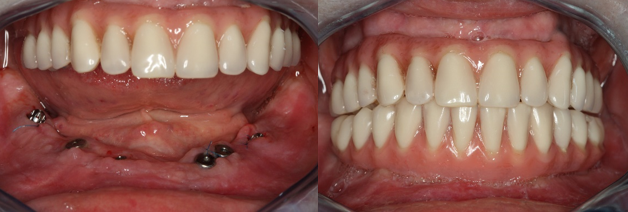 Resultado de los implantes dentales antes y después